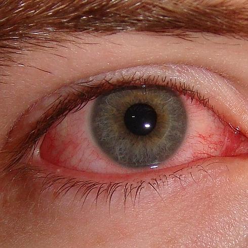 Conjuntivitis